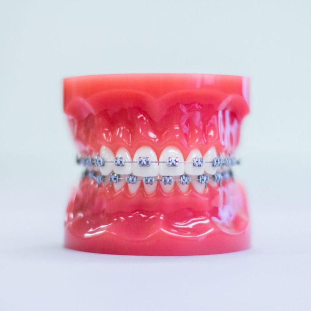 Custom, 3D-Printed Clear Braces - Inman Park Orthodontics